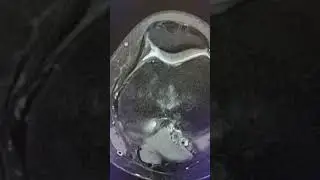 Grade 3 Chondromalacia Patella