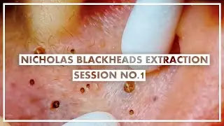 Nicholas 1st Session - Ear, Forehead and Cheeks Blackheads Extraction