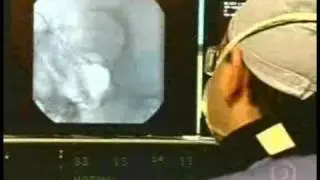 BRAIN ANEURYSM-ANEURISMA CEREBRAL