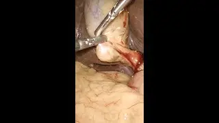 Stone-filled gallbladder during laparoscopic cholecystectomy 