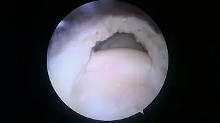 SCOI row Rotator cuff repair and suprapectoral biceps tenodesis 11.21.22 MF