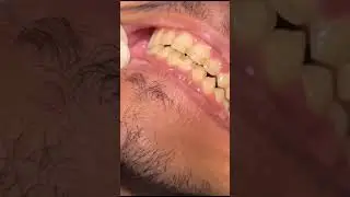 فك التقويم المعدني و تنظيف الاسنان وازاله الجير مع دكتور احمد ابرهيم  