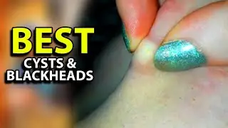 Giant blackheads & Severe cystic acne squeezed (4) | Blackhead King
