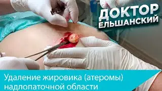 Удаление жировика атеромы надлопаточной области