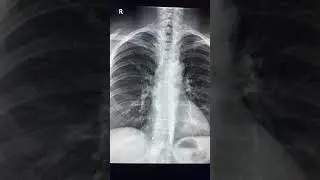 Right cardiophrenic angle opacity - Most common cause ?