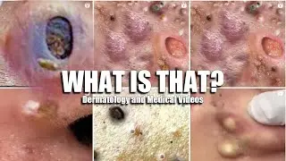 Blackheads, Whiteheads, Blackhead, Whitehead!