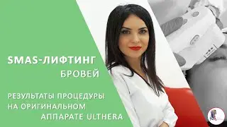 SMAS -лифтинг бровей. Результаты процедуры на оригинальном аппарате Ulthera