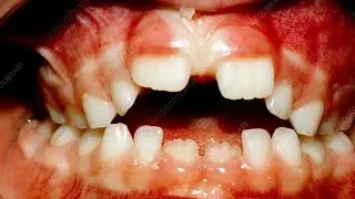Thumb Sucking Dangers: How It Can Harm Your Child’s Teeth & Jaw