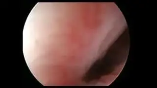 Shawki Hysteroscopy Septum vaginoscopic insertion technique nice