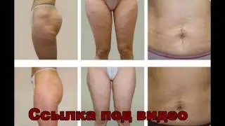 Как убрать целлюлит с ягодиц