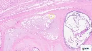 Testis: Teratoma Microscopy - Talking slide