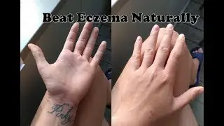 5 PROVEN Tips for Treating Severe Eczema