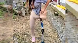See How a High Amputee Girl Tying Prosthetic Leg to the Hip to Avoid Falling off