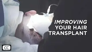 After my Hair Transplant