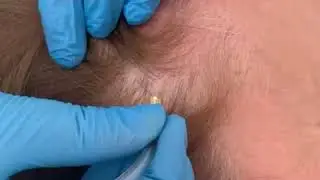 CARBOXYTHERAPY FOR HAIR LOSS
