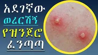 አደገኛው ወረርሽኝ እየመጣ ነው የዝንጀሮ ፈንጣጣ Monkeypox
