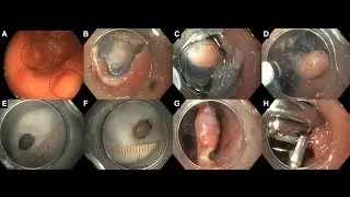 Pocket-assisted ESD for gastric submucosal lesions