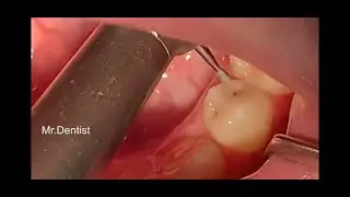Composite Dental Fillings    !!!!!