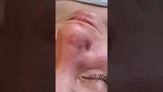 Limpeza profunda da la piel