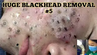 #blackhead removal ASMR Video