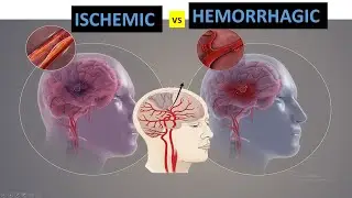 what is the difference between ischemic and hemorrhagic stroke?