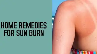 Quick home remedies for sunburn pain relief