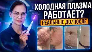 Холодная плазма, что это? Вся правда и реальные ДО/ПОСЛЕ по более,чем 20 проблемам.