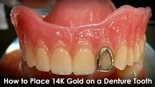 How to Place 14K Gold on a Denture Tooth