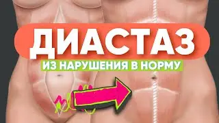 ДИАСТАЗ: консервативное лечение