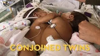 Conjoined twins separated at the University of Minnesota