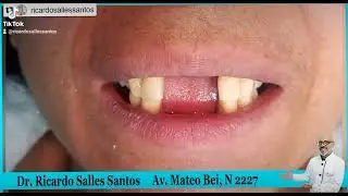Ponte de grampo resolve sim
