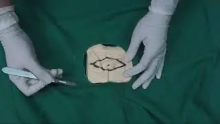 Eksisi Atheroma