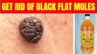 How To Get Rid of Black Flat Moles With Apple Cider Vinegar / Flat Moles Treatment