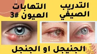 التدريب الصيفي لطلاب الصيدلة | حالات العين ( الجنيجل او الجنجل) Eye conditions #3 Styes &Chalazion