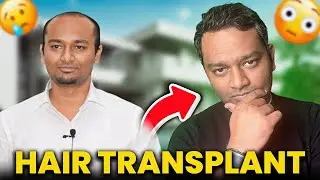 After Hair Transplant Side effects Reality