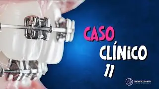Caso Clínico 11- Entendendo a Mordida Aberta esquelética