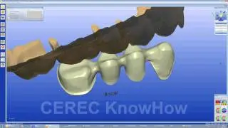 CEREC® Bridge Framework  - Bridge - Software