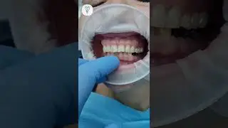 Из обычной пациентки в гнатологическую для максимального результата. Имплантация зубов.