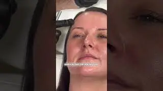 Botox brow lift injection points