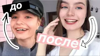 МНЕ СНЯЛИ БРЕКЕТЫ//МОЯ ИСТОРИЯ