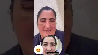 Блефаропластика Ташкент