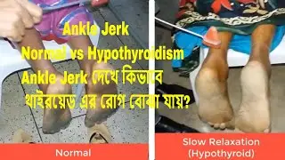 Ankle jerk slow relaxation Hypothyroid Vs Normal ankle jerk.