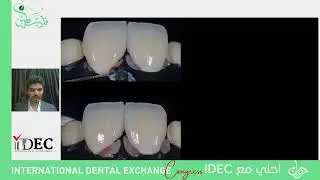 مع نجم الVeneer  العملاق المصري محبوب الجماهير  #الدكتور_إسلام_زقزوق 🇪🇬