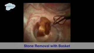 Stone Removal with Basket