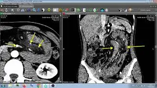 ЭФФЕКТ МИШЕНИ - target effect on ct .