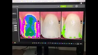 ShadeWave DIGITAL SHADE TAKING, Absolute Dental Lab