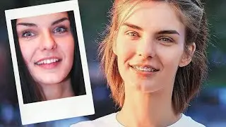 БРЕКЕТЫ●ОДИН Год●КАК ПРИКУС МЕНЯЕТ ЛИЦО●Ирригатор ДО И ПОСЛЕ