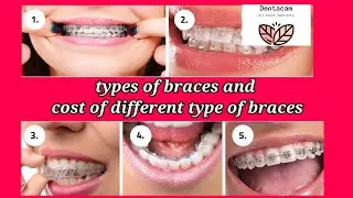 Types of Braces,COST of BRACES in India (hindi) - Pros and Cons of Braces