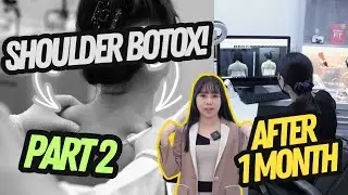 Yan's Shoulder Botox (Traptox) Treatment Results | Part 2: Before & After at RJ Clinic
