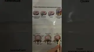 Что такое протрузия? И что такое грыжа межпозвоночного диска?
